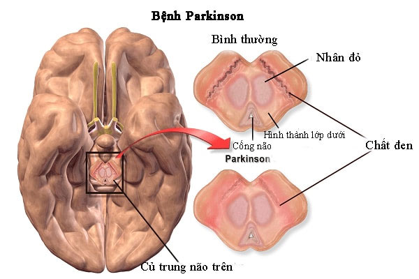 Suy giảm chất đen trong não ở người bệnh Parkinson